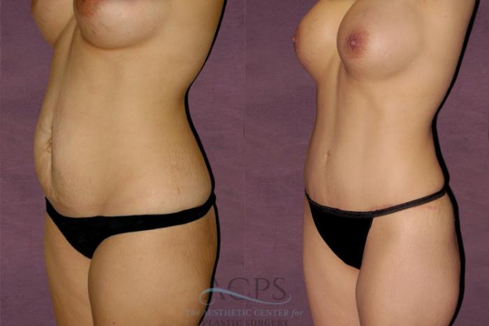 Before & After Mommy Makeover Case 175 Oblique Left View: View in Houston, TX