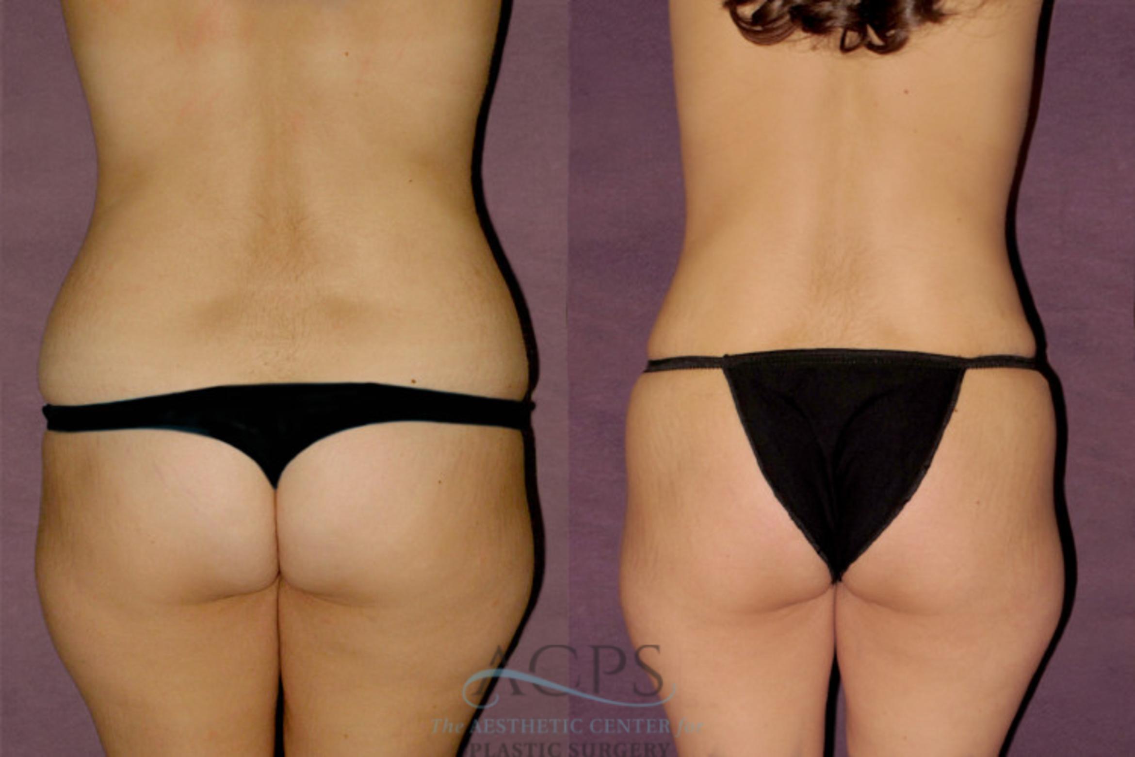 Before & After Mommy Makeover Case 175 Rear View: View in Houston, TX