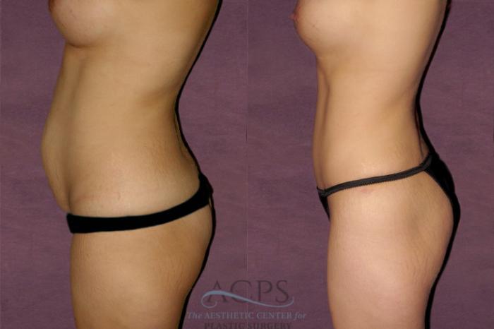 Before & After Mommy Makeover Case 175 Side Left View: View in Houston, TX