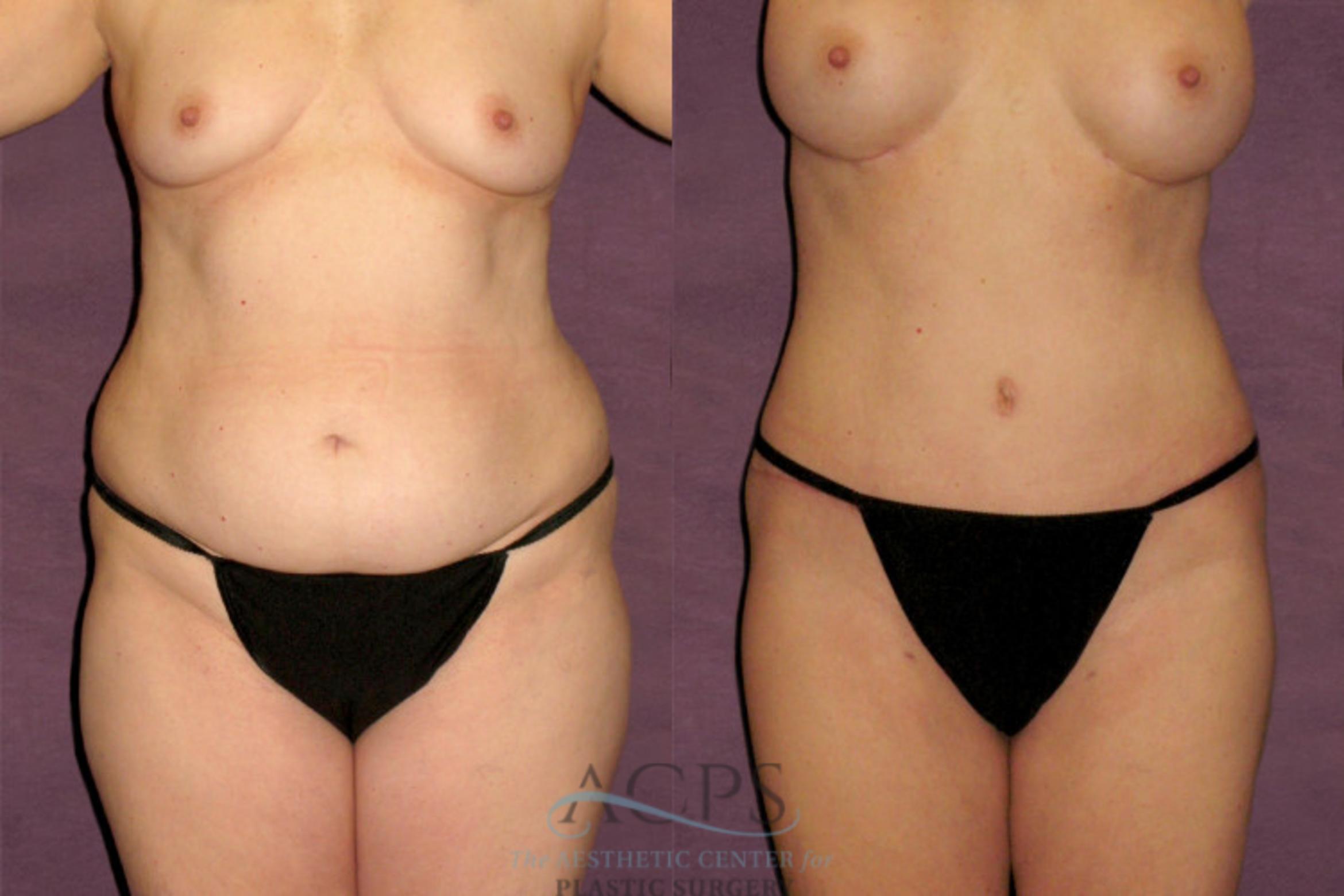 Before & After Tummy Tuck Case 176 Front View: View in Houston, TX