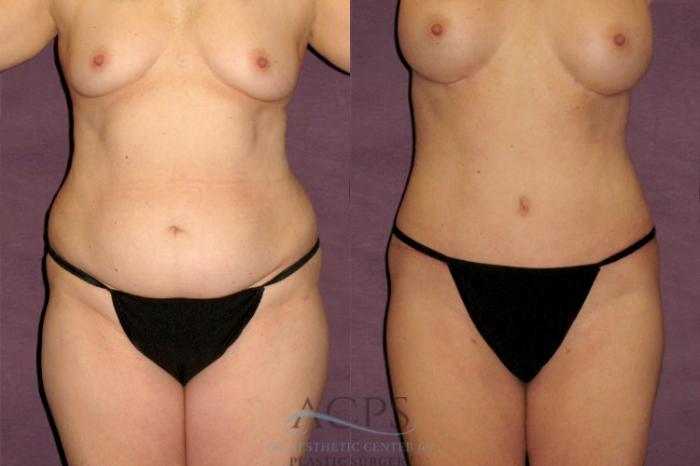 Before & After Tummy Tuck Case 176 Front View: View in Houston, TX