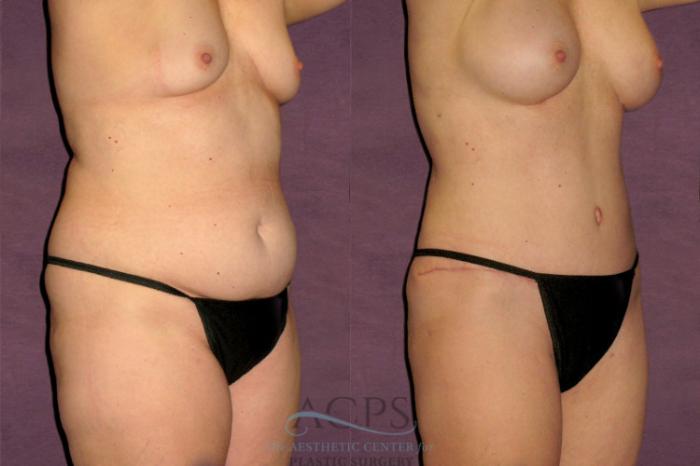 Before & After Tummy Tuck Case 176 Oblique Right View: View in Houston, TX