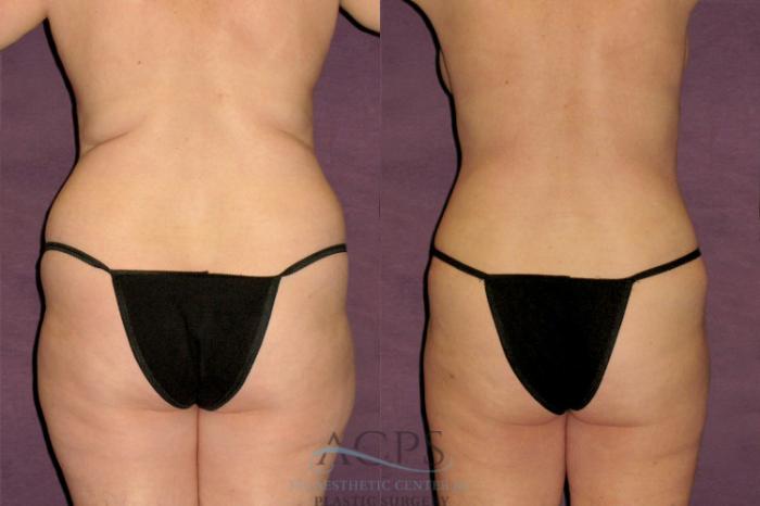 Before & After Tummy Tuck Case 176 Rear View: View in Houston, TX