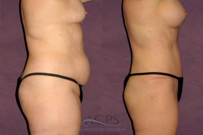 Before & After Tummy Tuck Case 176 Side Right View: View in Houston, TX