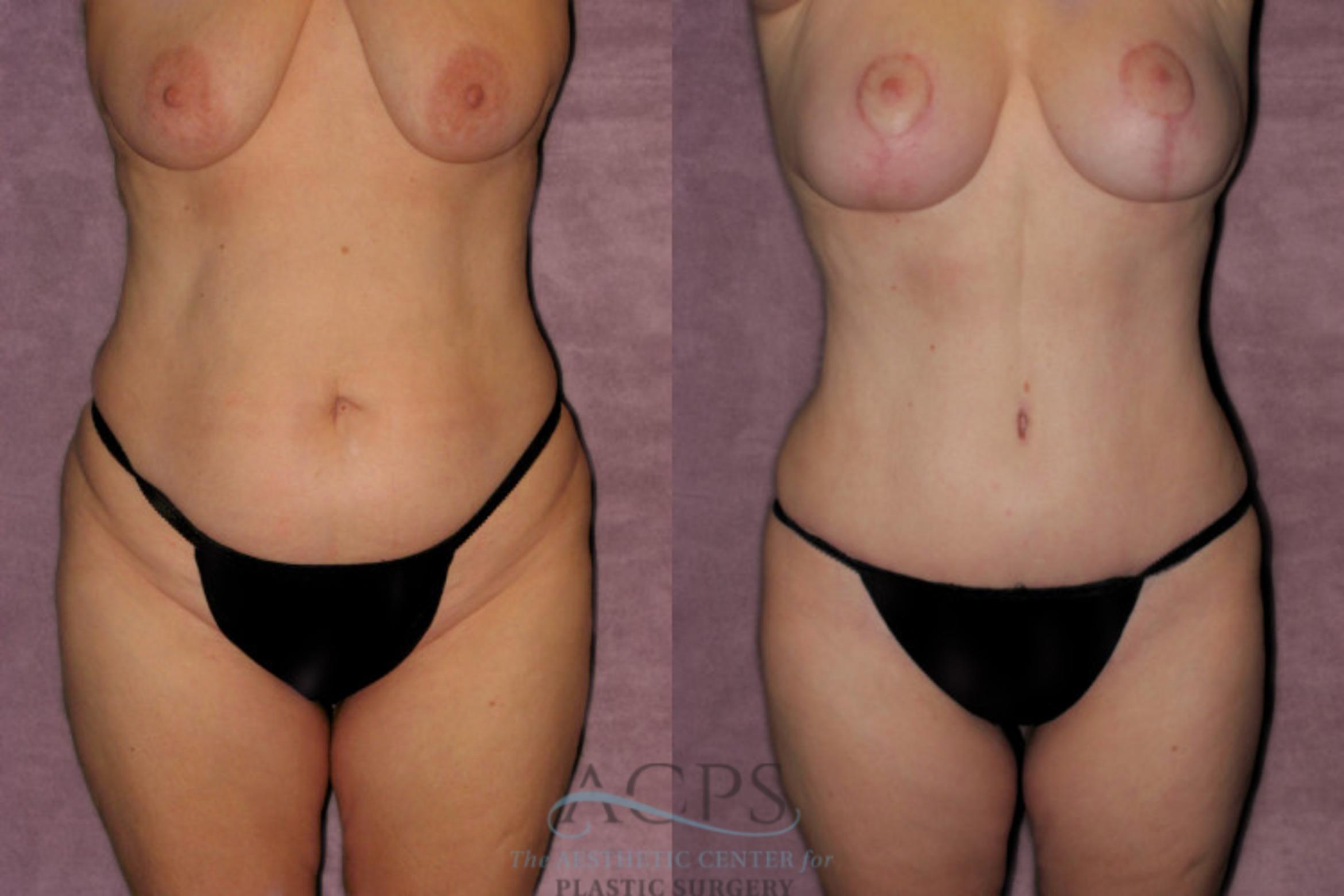 Before & After Tummy Tuck Case 177 Front View: View in Houston, TX