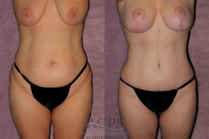 Before & After Tummy Tuck Case 177 Front View: View in Houston, TX
