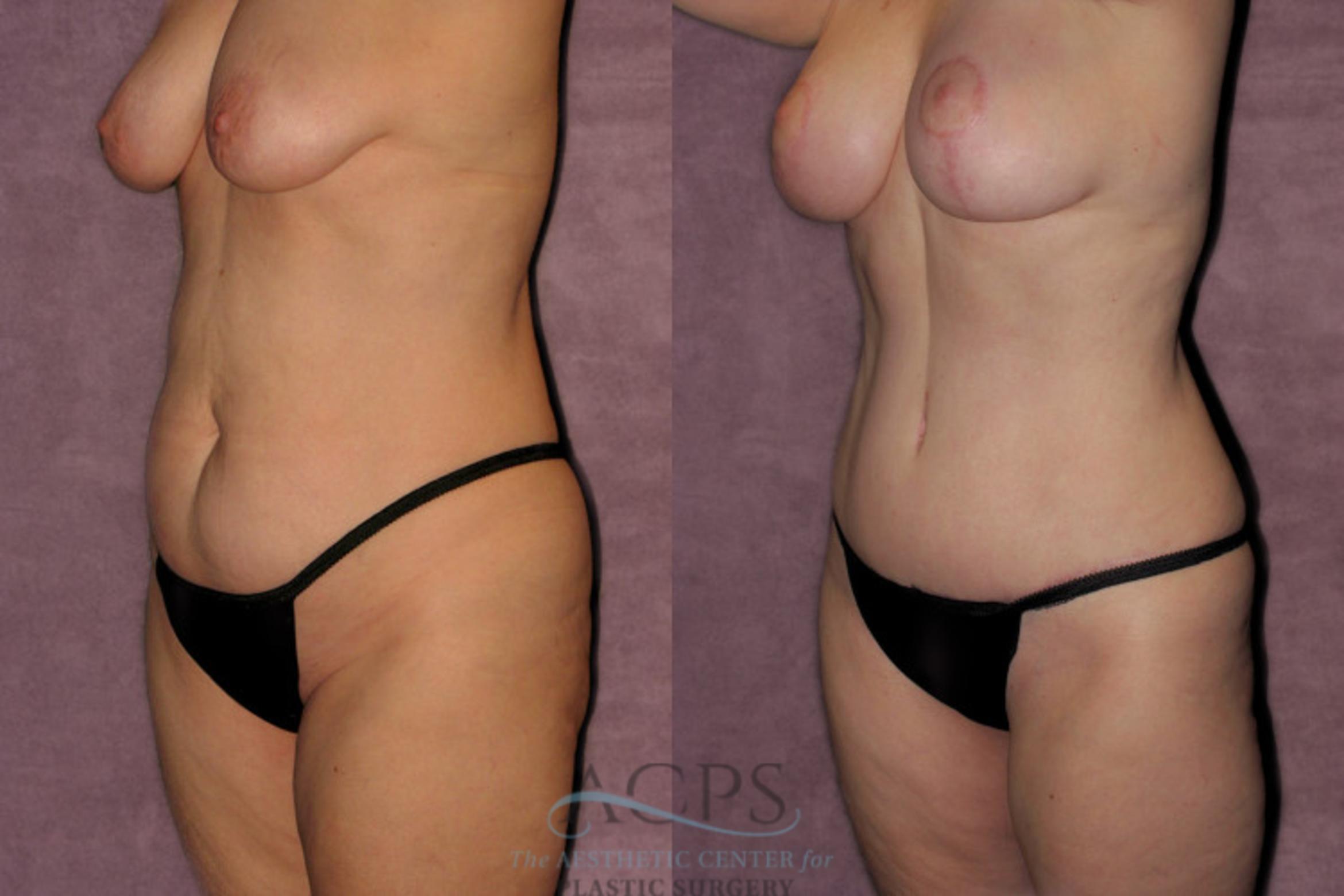 Before & After Tummy Tuck Case 177 Oblique Left View: View in Houston, TX