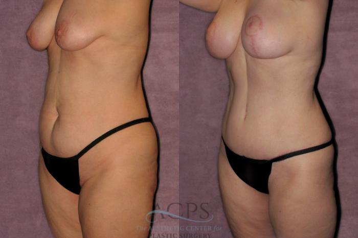Before & After Tummy Tuck Case 177 Oblique Left View: View in Houston, TX