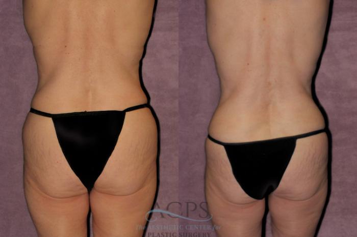 Before & After Tummy Tuck Case 177 Rear View: View in Houston, TX