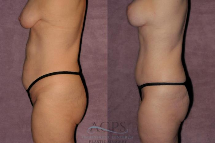 Before & After Tummy Tuck Case 177 Side Left View: View in Houston, TX