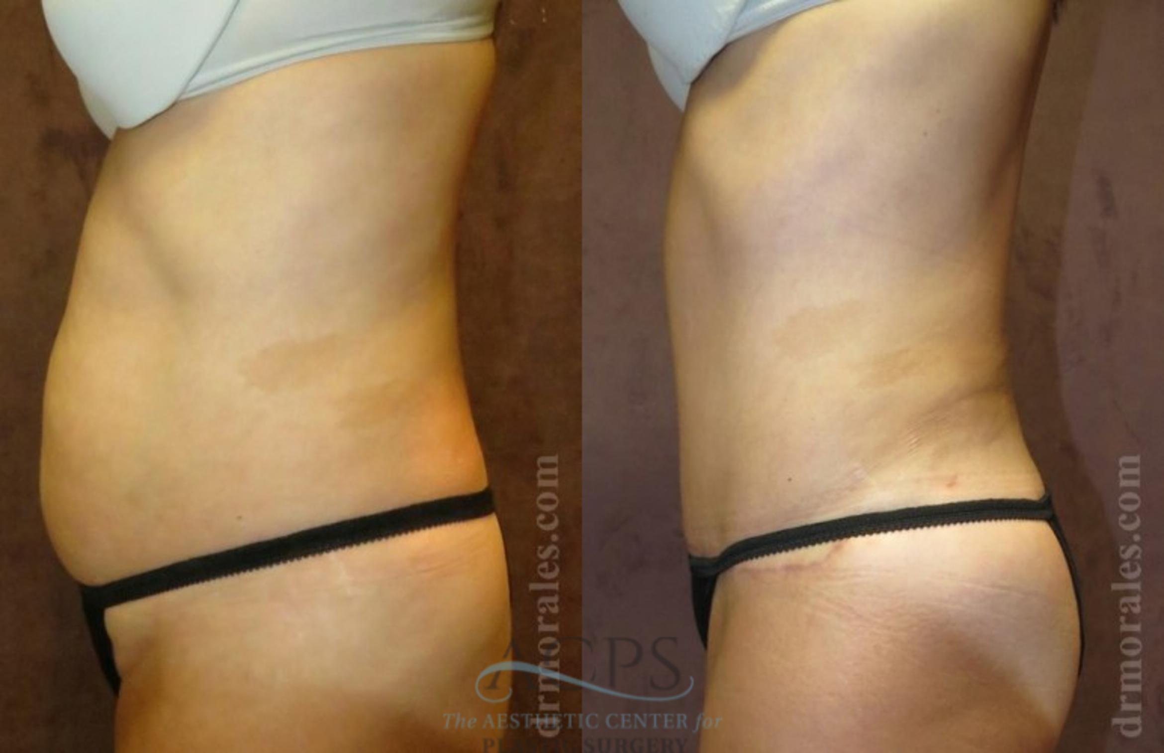Before & After Tummy Tuck Case 178 Side View: View in Houston, TX