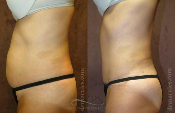Before & After Tummy Tuck Case 178 Side View: View in Houston, TX