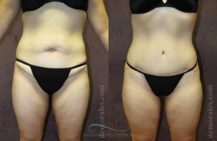 Before & After Tummy Tuck Case 179 Front View: View in Houston, TX