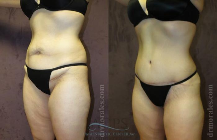 Before & After Tummy Tuck Case 179 Oblique View: View in Houston, TX