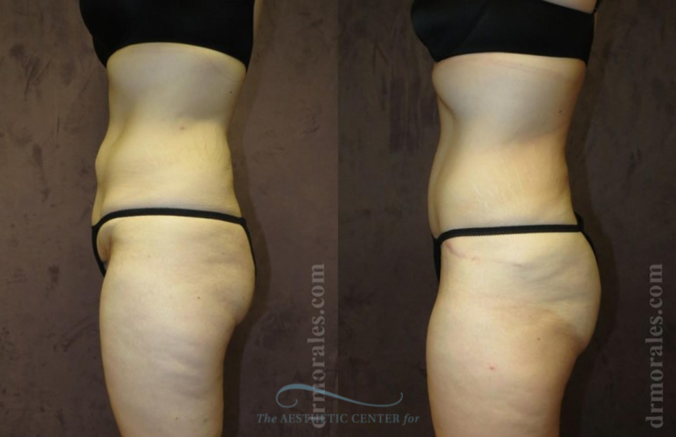 Before & After Tummy Tuck Case 179 Side View: View in Houston, TX