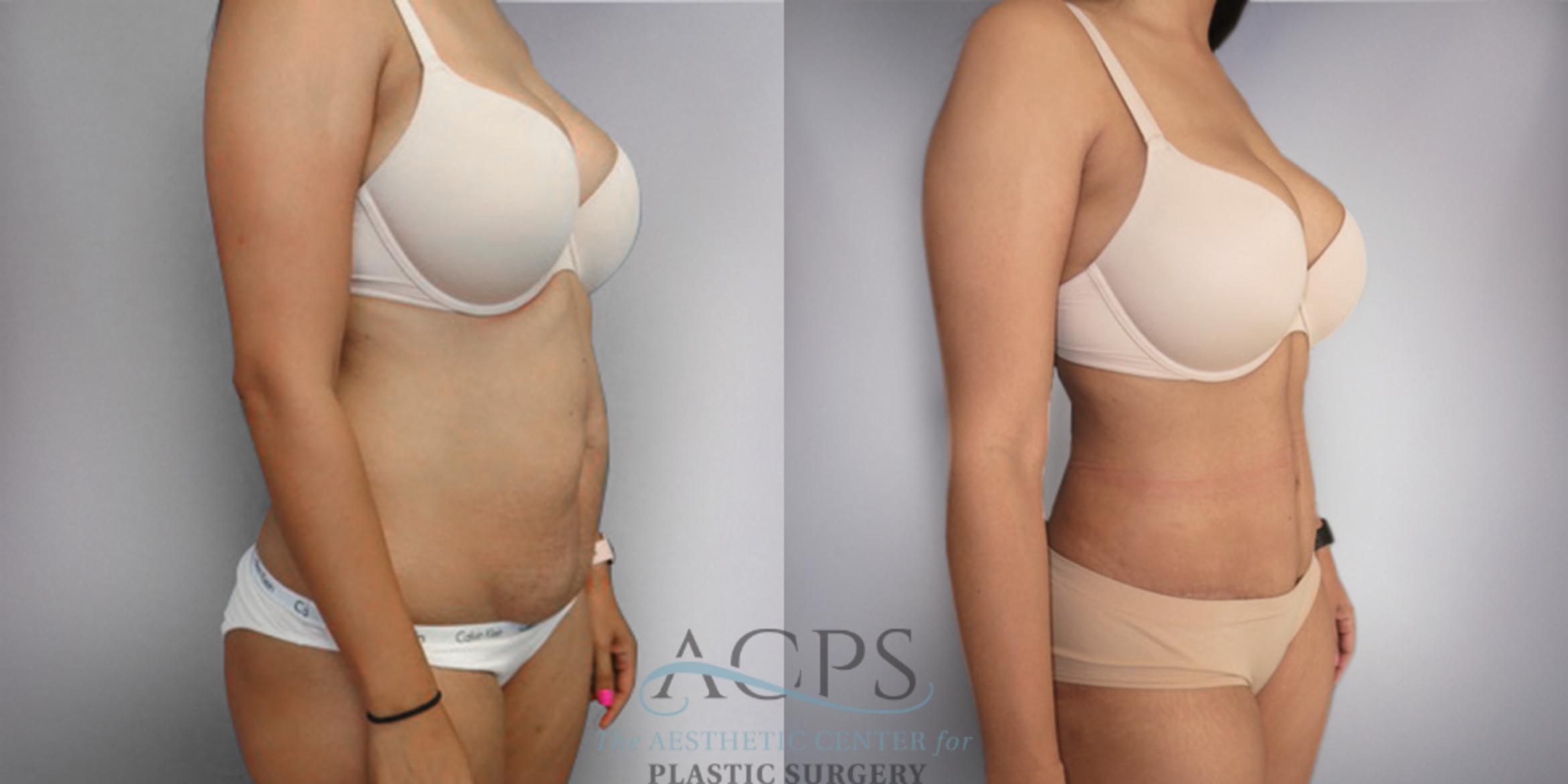 Before & After Tummy Tuck Case 18 Oblique Right View: View in Houston, TX