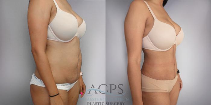 Before & After Tummy Tuck Case 18 Oblique Right View: View in Houston, TX