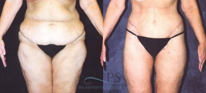 Before & After Tummy Tuck Case 180 Front View: View in Houston, TX