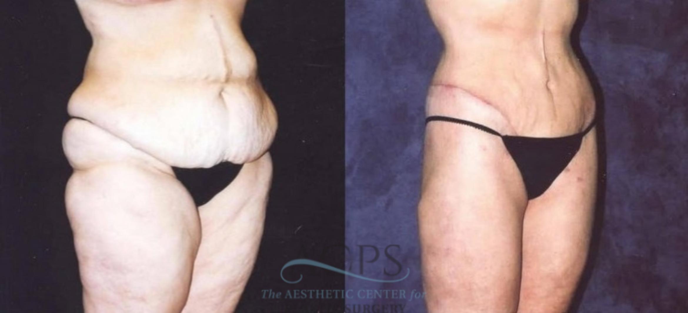 Before & After Tummy Tuck Case 180 Oblique View: View in Houston, TX