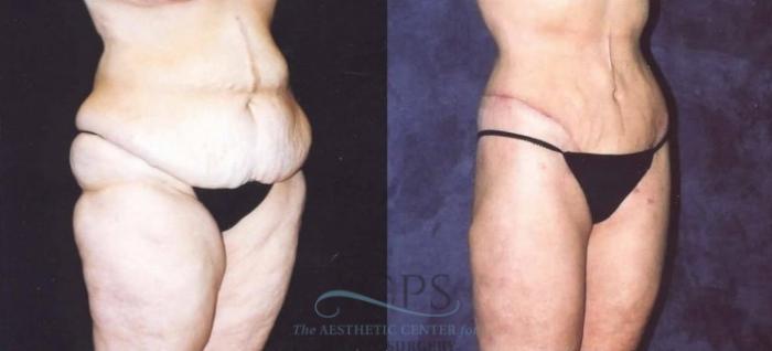 Before & After Tummy Tuck Case 180 Oblique View: View in Houston, TX