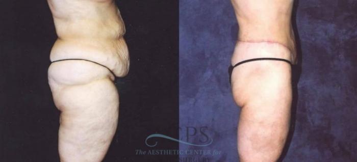 Before & After Tummy Tuck Case 180 Side View: View in Houston, TX