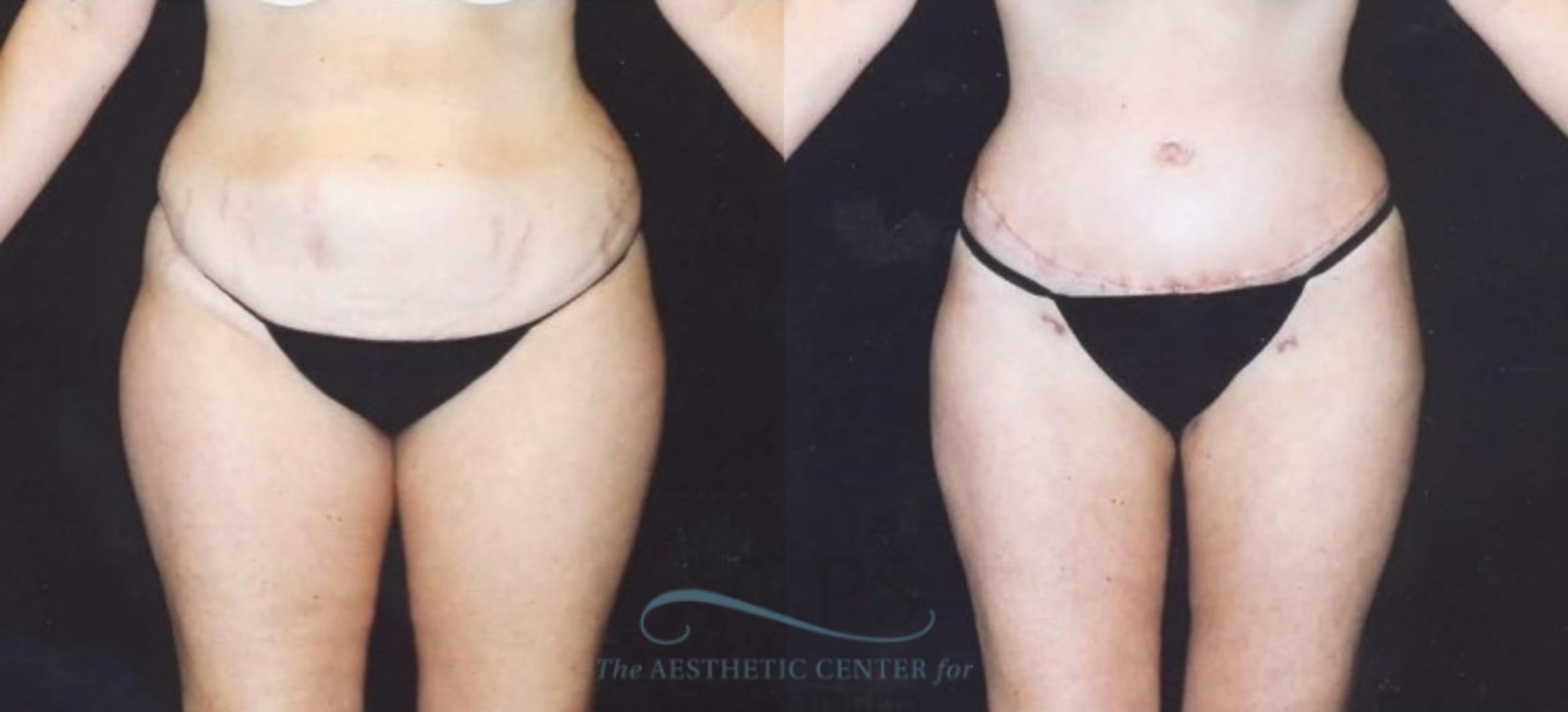 Before & After Tummy Tuck Case 181 Front View: View in Houston, TX