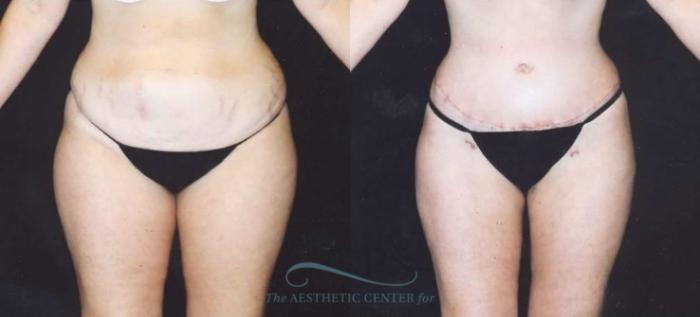 Before & After Tummy Tuck Case 181 Front View: View in Houston, TX