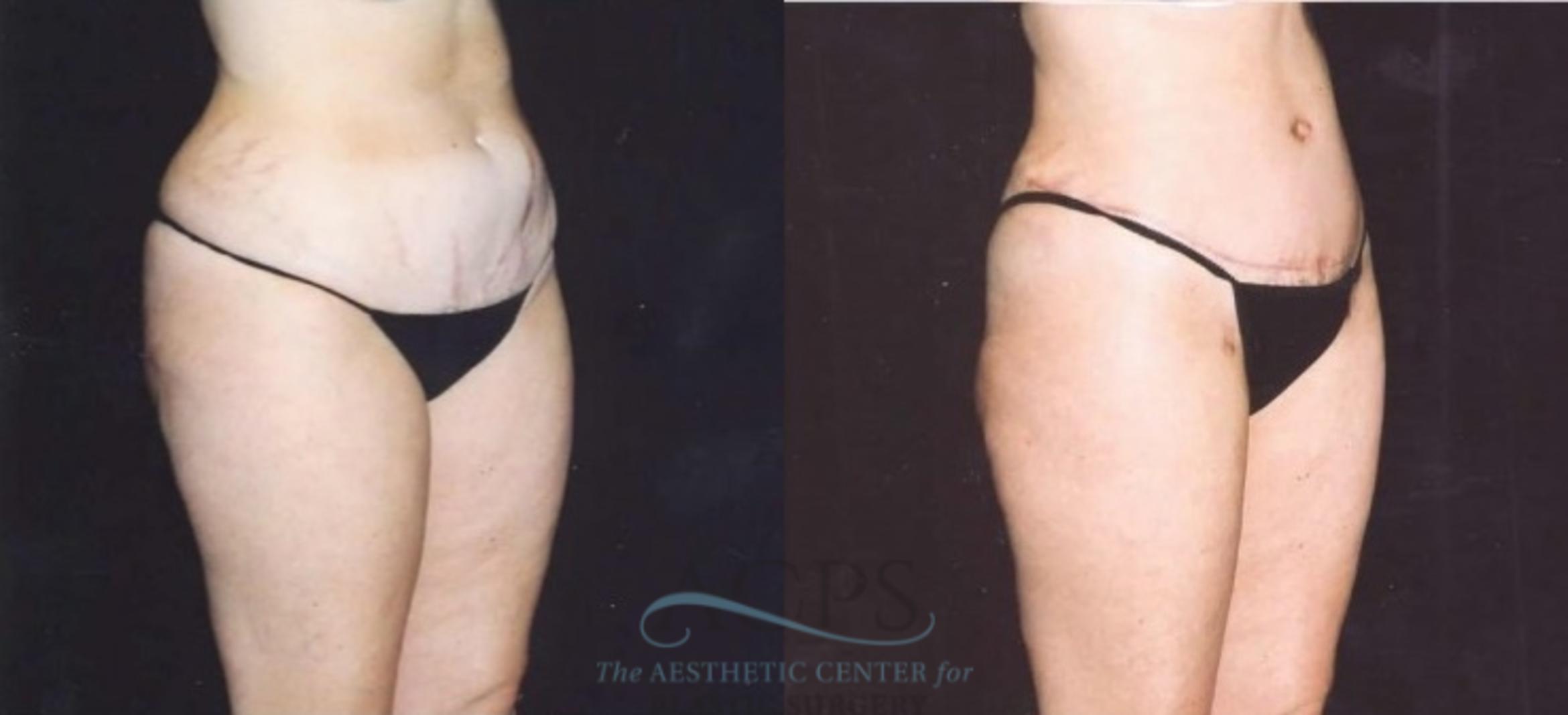 Before & After Tummy Tuck Case 181 Oblique View: View in Houston, TX