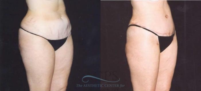Before & After Tummy Tuck Case 181 Oblique View: View in Houston, TX