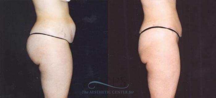 Before & After Tummy Tuck Case 181 Side View: View in Houston, TX