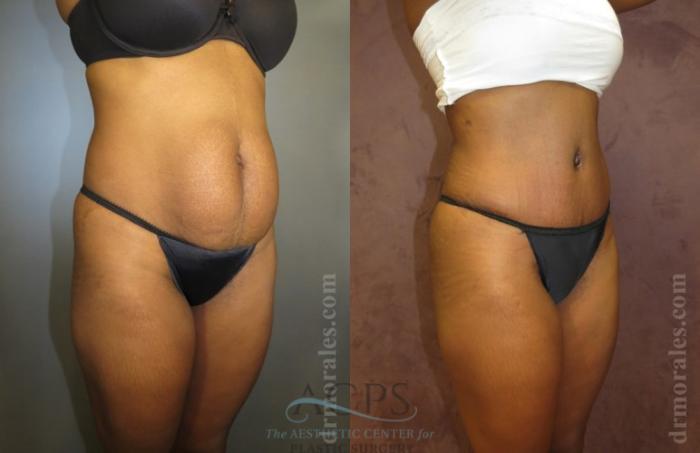 Before & After Tummy Tuck Case 182 Oblique View: View in Houston, TX