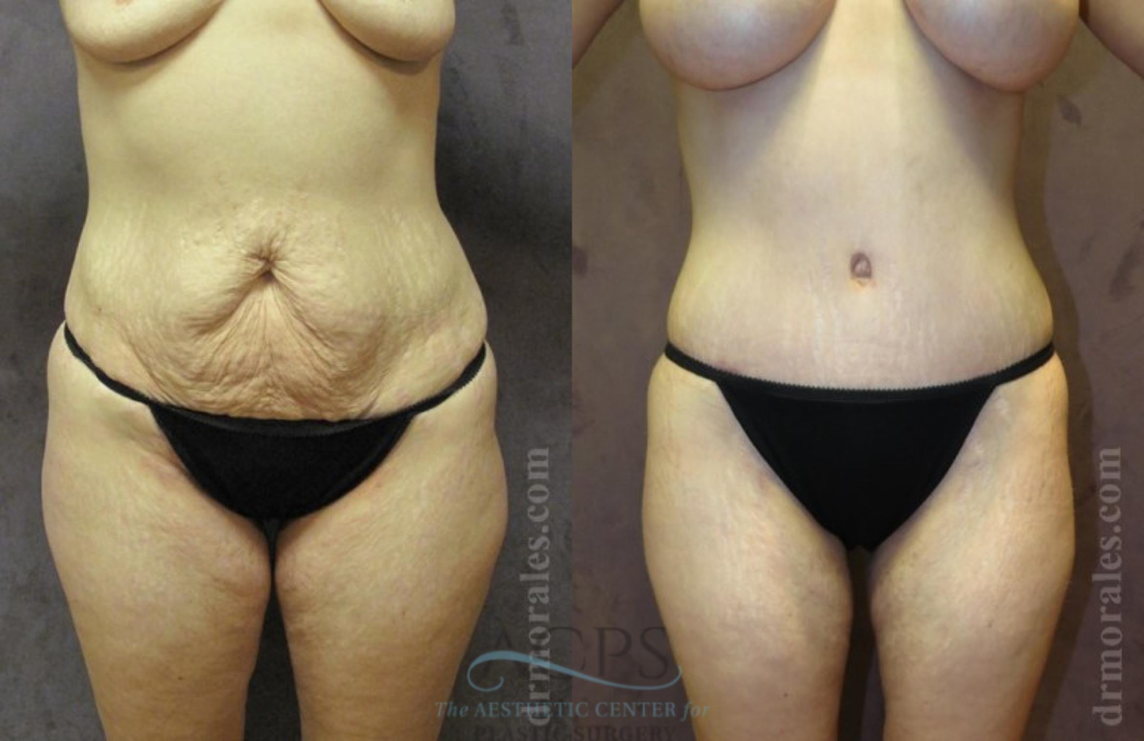 Before & After Tummy Tuck Case 183 Front View: View in Houston, TX