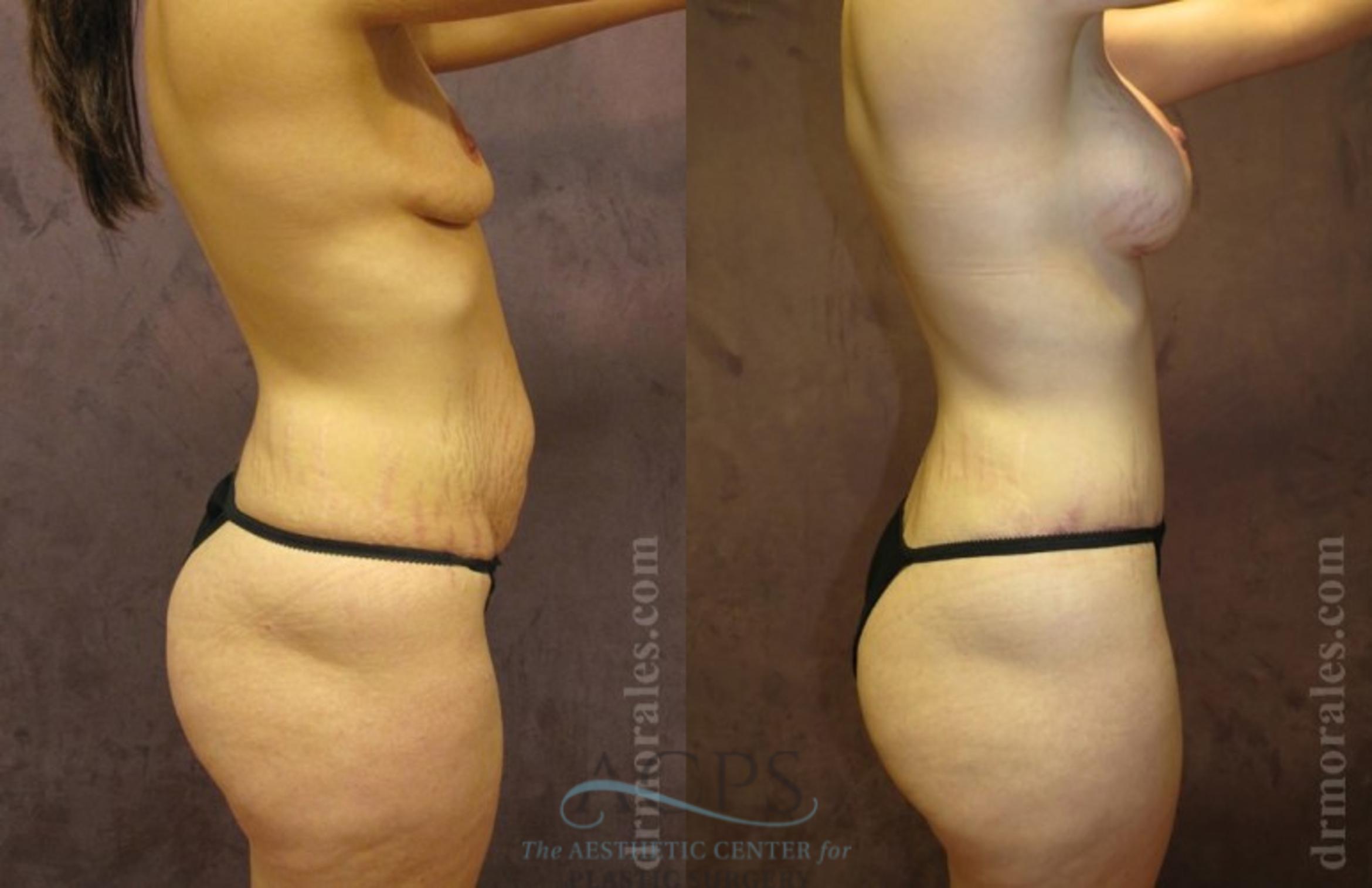 Before & After Tummy Tuck Case 183 Side View: View in Houston, TX