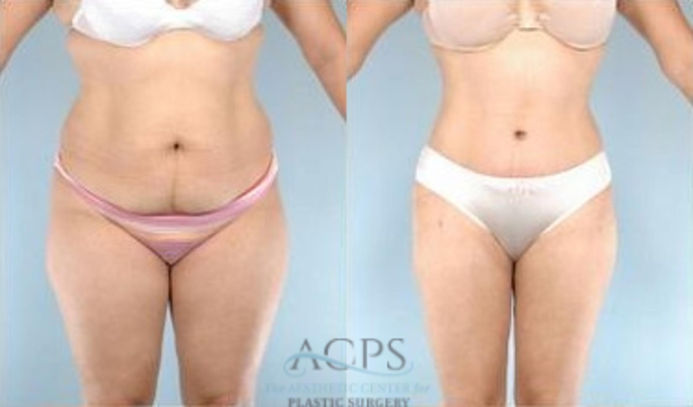 Before & After Tummy Tuck Case 184 Front View: View in Houston, TX
