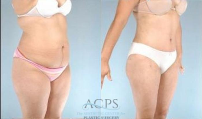 Before & After Tummy Tuck Case 184 Oblique View: View in Houston, TX