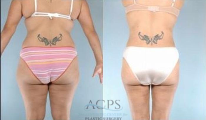 Before & After Tummy Tuck Case 184 Rear View: View in Houston, TX