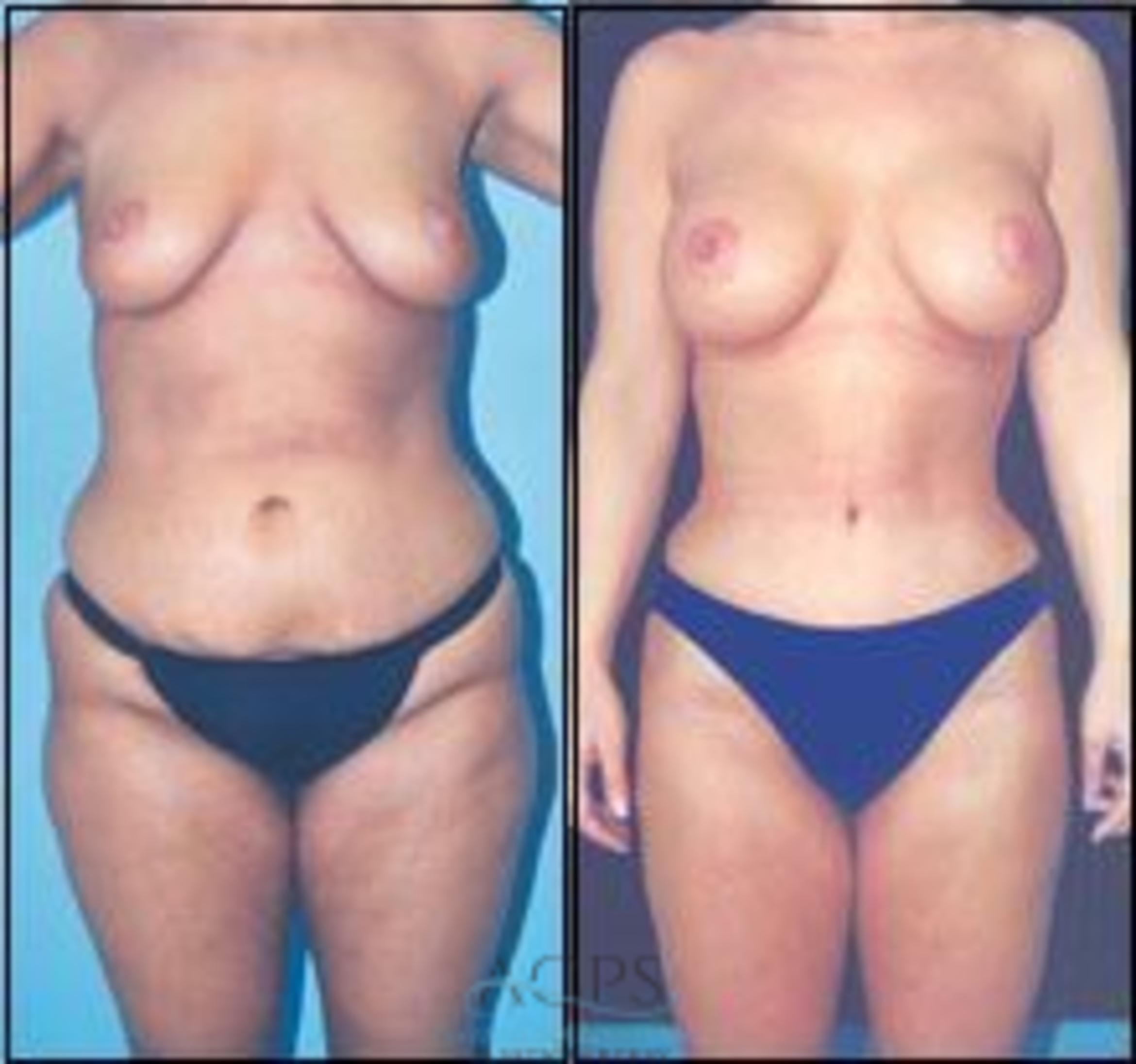 Before & After Tummy Tuck Case 185 Front View: View in Houston, TX