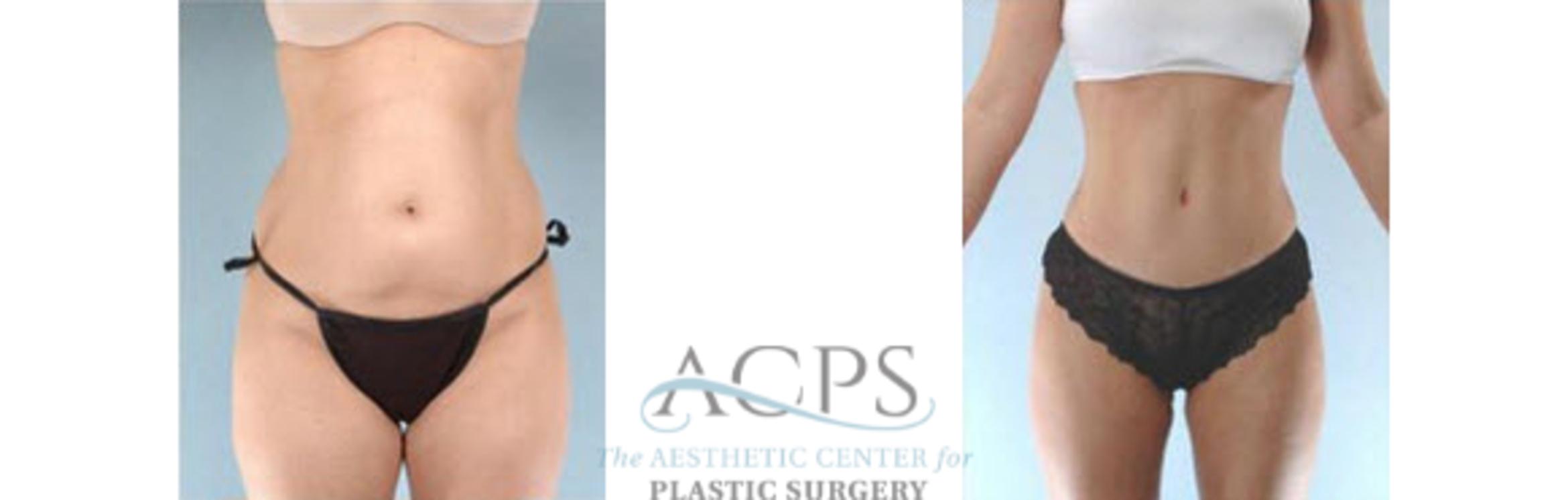 Before & After Tummy Tuck Case 186 Front View: View in Houston, TX