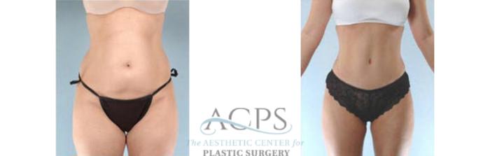 Before & After Tummy Tuck Case 186 Front View: View in Houston, TX