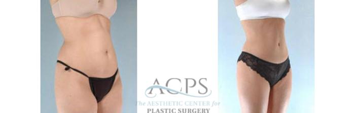 Before & After Tummy Tuck Case 186 Oblique View: View in Houston, TX