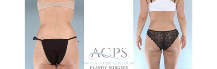 Before & After Tummy Tuck Case 186 Rear View: View in Houston, TX