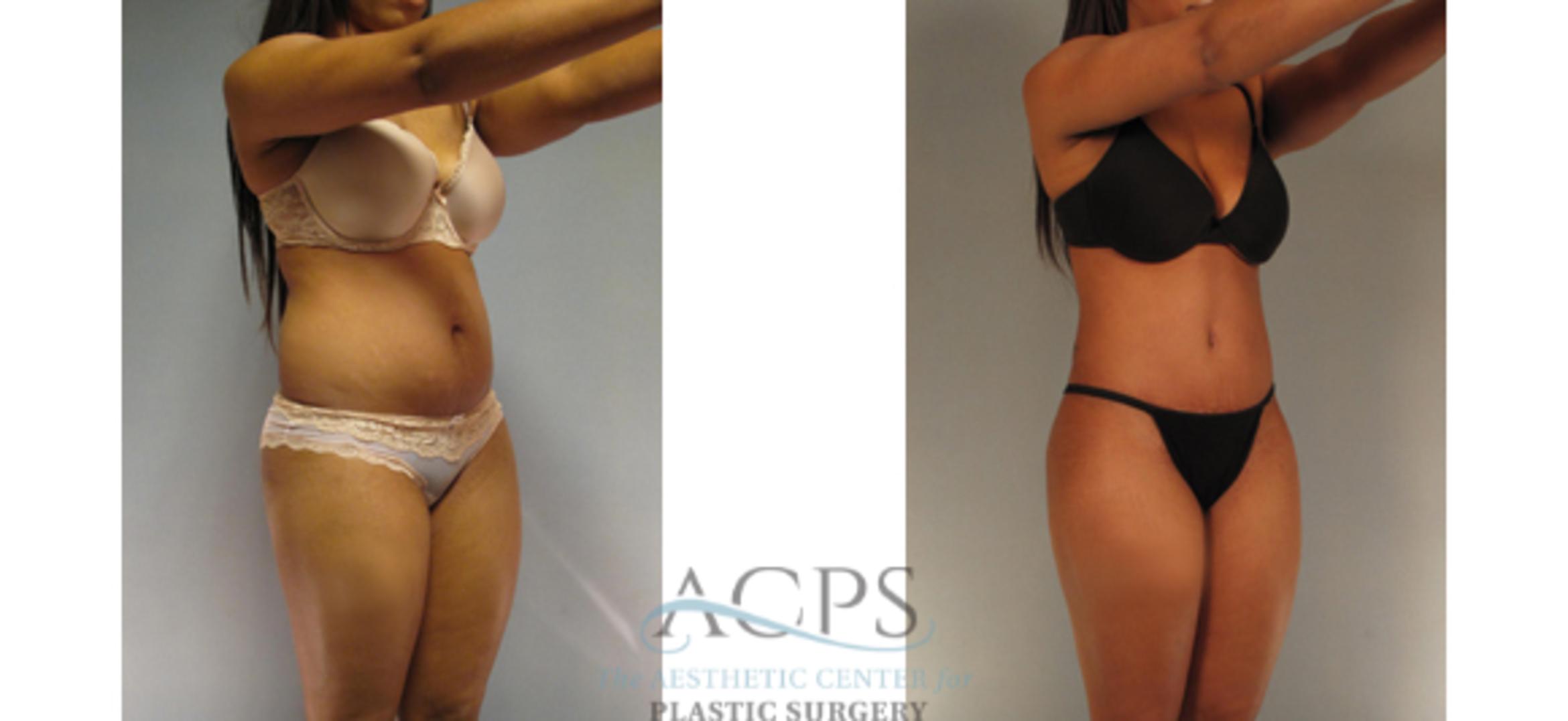 Before & After Tummy Tuck Case 187 Oblique View: View in Houston, TX
