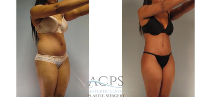 Before & After Tummy Tuck Case 187 Oblique View: View in Houston, TX
