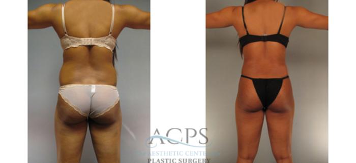 Before & After Tummy Tuck Case 187 Rear View: View in Houston, TX