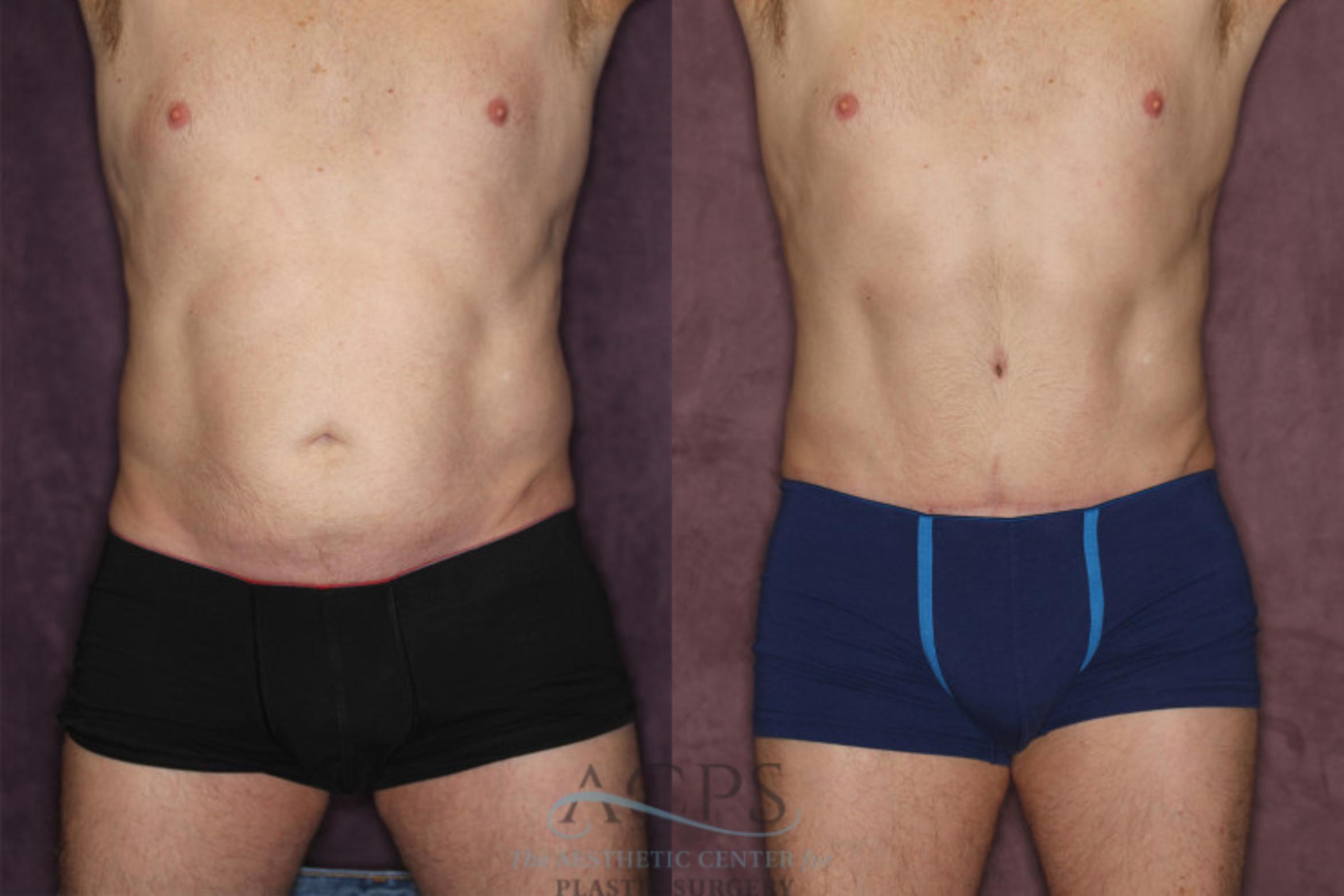 Before & After Tummy Tuck Case 19 Front View: View in Houston, TX