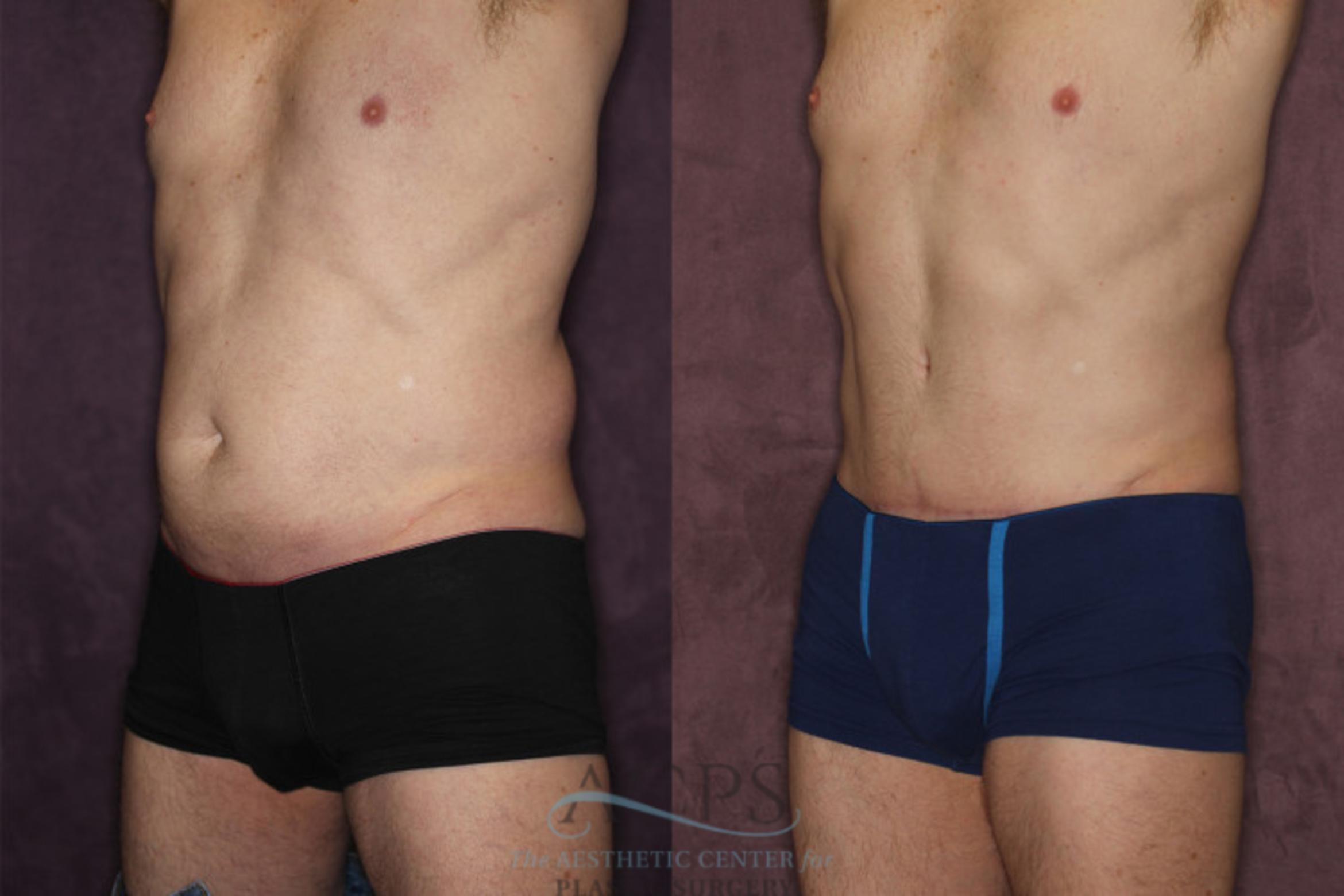 Before & After Tummy Tuck Case 19 Oblique Left View: View in Houston, TX