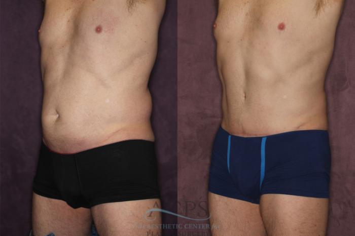 Before & After Tummy Tuck Case 19 Oblique Left View: View in Houston, TX