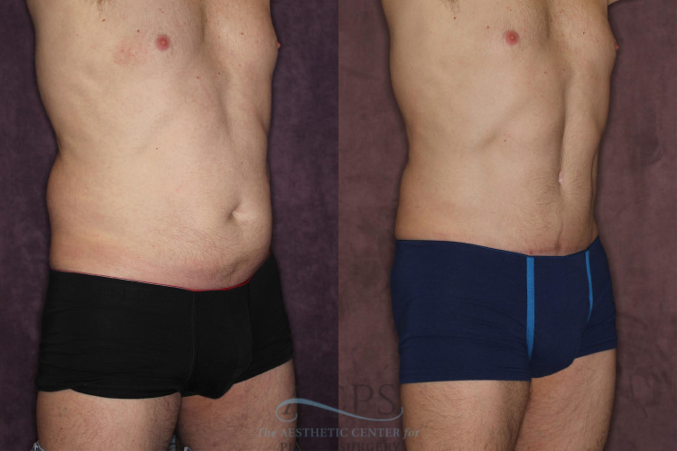 Before & After Tummy Tuck Case 19 Oblique Right View: View in Houston, TX