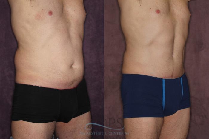 Before & After Tummy Tuck Case 19 Oblique Right View: View in Houston, TX