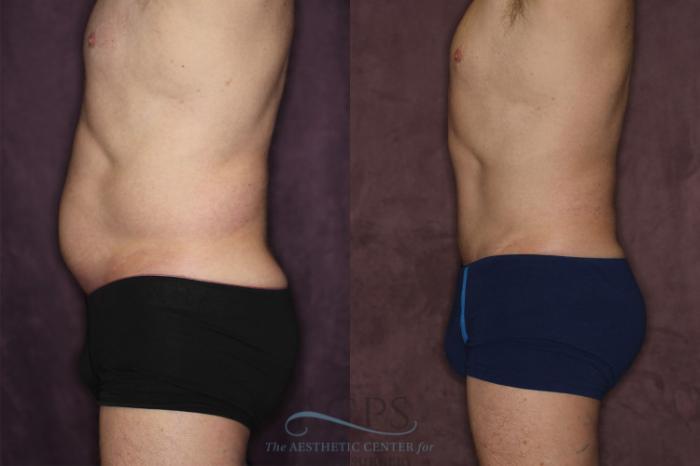 Before & After Tummy Tuck Case 19 Side Left View: View in Houston, TX